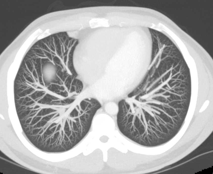 Inflammatory Nodule Left Lung - CTisus CT Scan