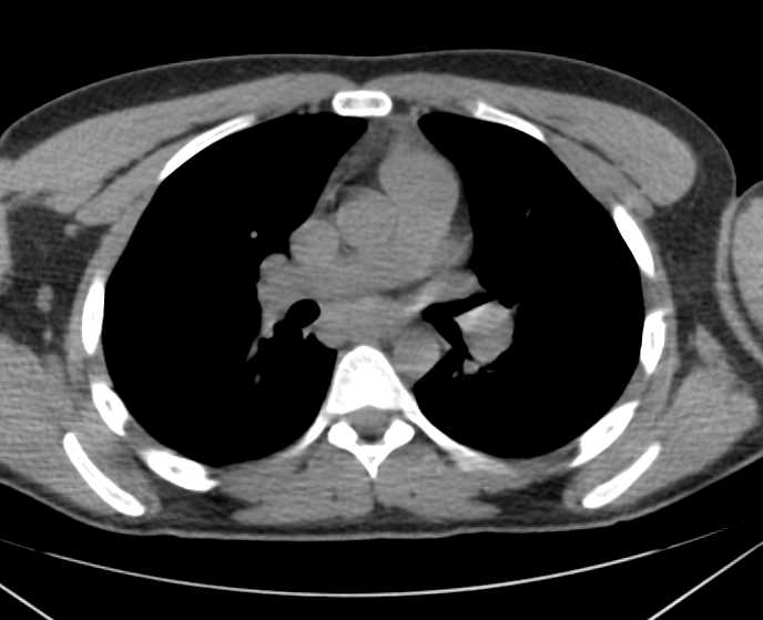 Sarcoidosis with Adenopathy - CTisus CT Scan
