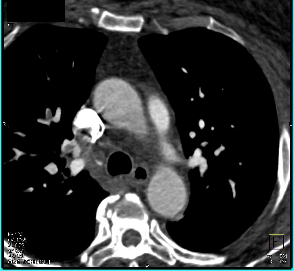 Multiple Pulmonary Emboli - CTisus CT Scan