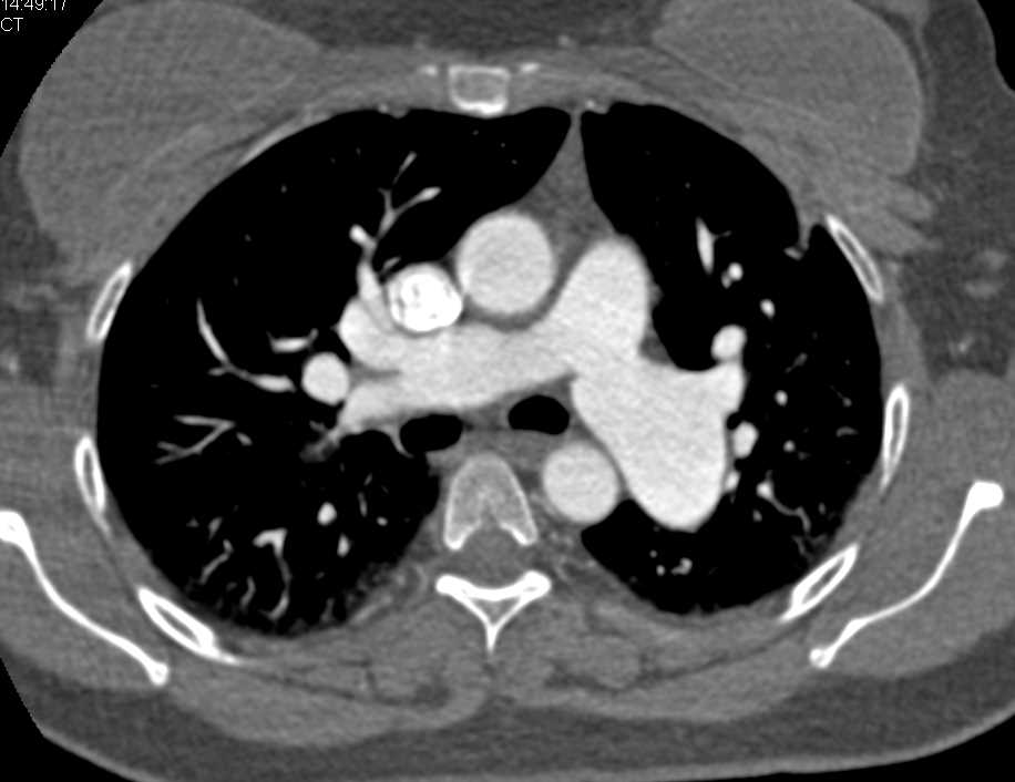 Dilated Left Pulmonary Artery - CTisus CT Scan