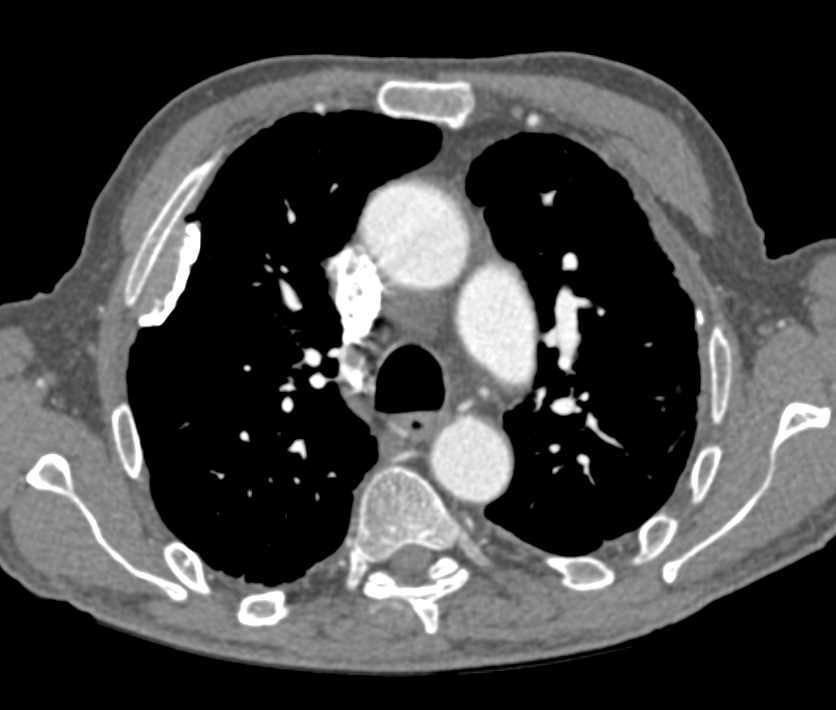 Calcified Pleural Plaques due to Asbestos Exposure - CTisus CT Scan