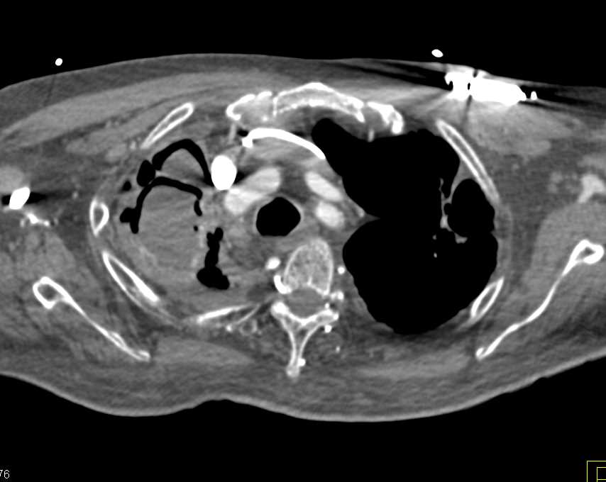 Cavitating Aspergilloma Right Upper Lung - CTisus CT Scan