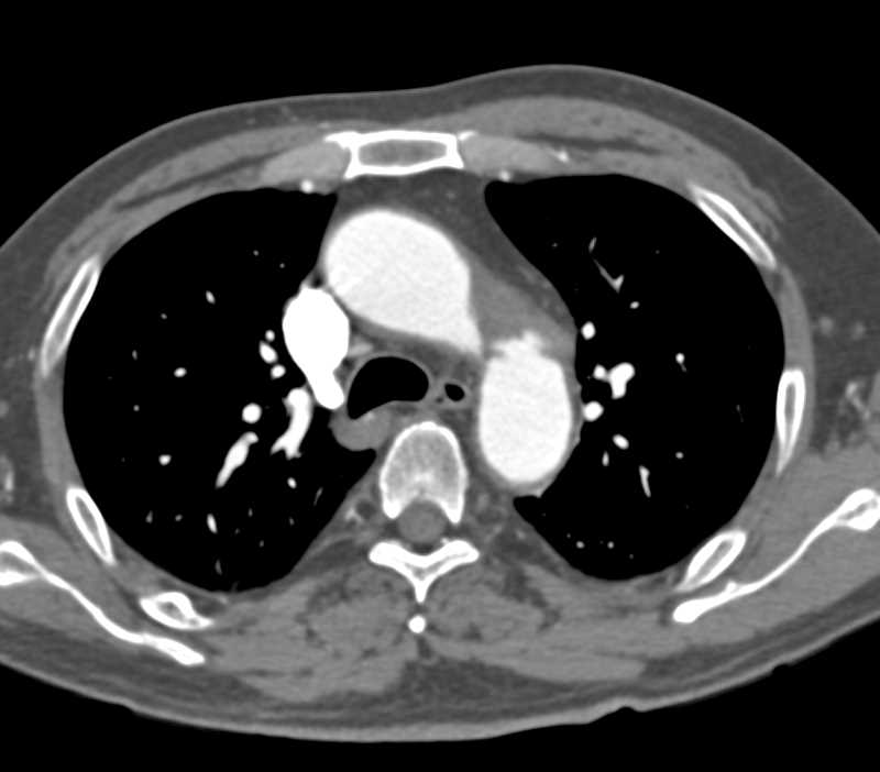 Occlusion Left Subclavian Artery - CTisus CT Scan