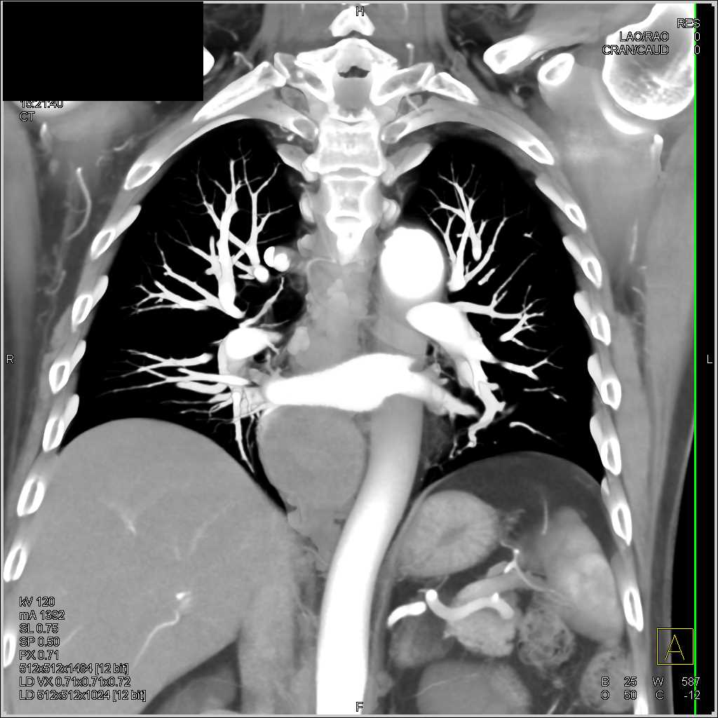 Occlusion Left Subclavian Artery - CTisus CT Scan