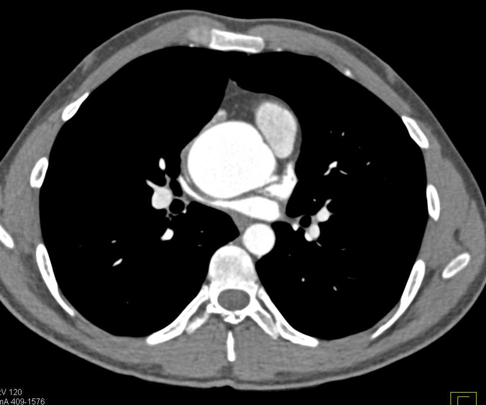 Thymoma with Blastic Bone Metastases - CTisus CT Scan