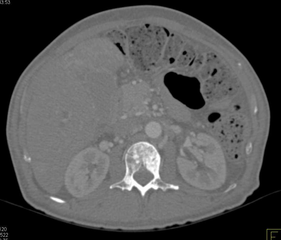 Thymoma with Blastic Bone Metastases - CTisus CT Scan