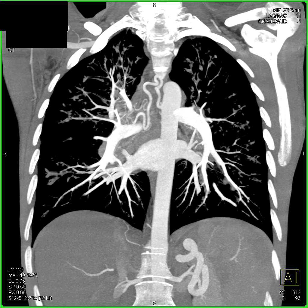 Peribronchial Thickening and Bronchiectasis in a Cystic Fibrosis Patient with Dilated Bronchial Arteries - CTisus CT Scan