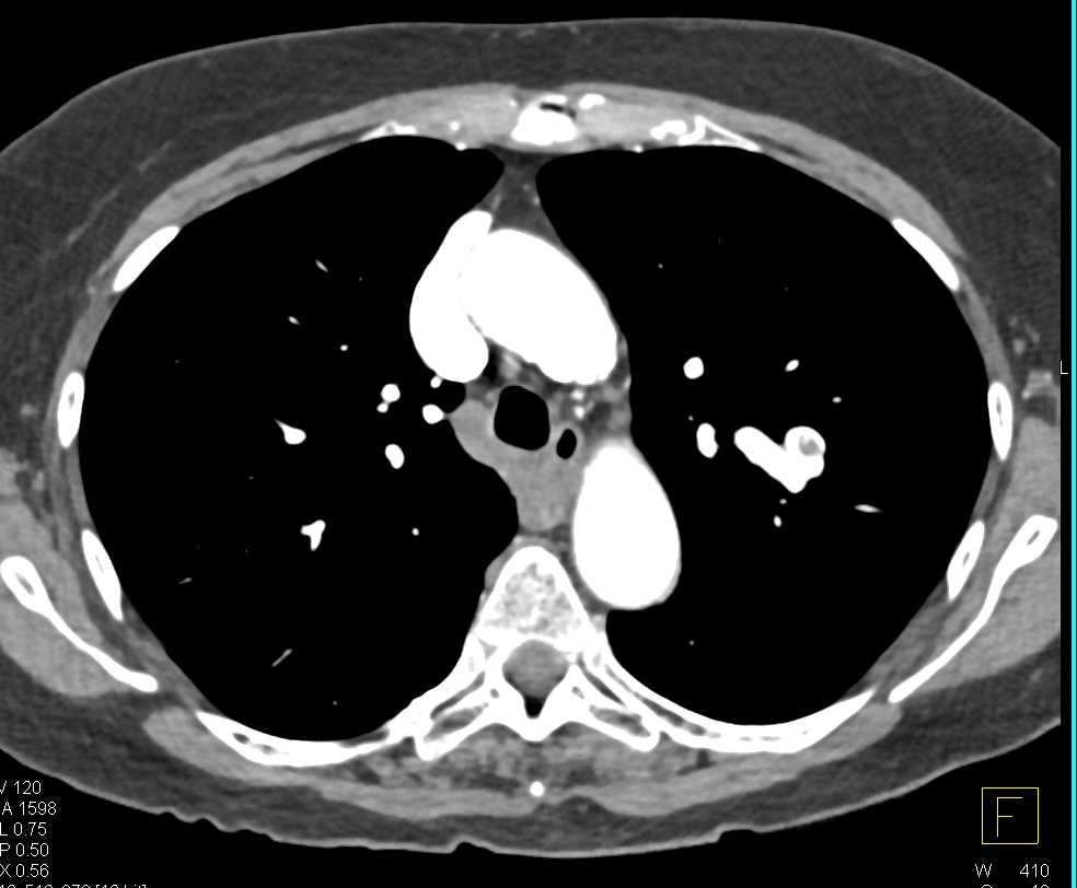 Embolized Pulmonary Arteriovenous Malformation (PAVM) in Left Upper Lobe - CTisus CT Scan