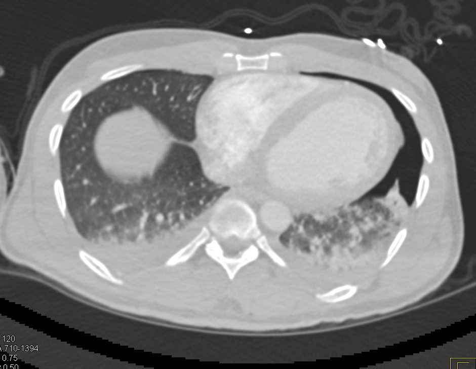 Left Pneumothorax - CTisus CT Scan