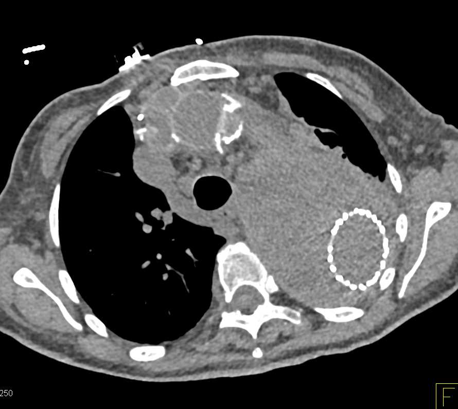 Endovascular Stent with Endoleak - CTisus CT Scan