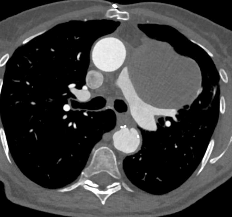 Thymoma with Multiple Implants Left Chest - CTisus CT Scan