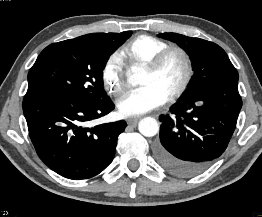 Multiple Pulmonary Emboli (PEs) in a Patient with Extensive Pancreatic Cancer - CTisus CT Scan