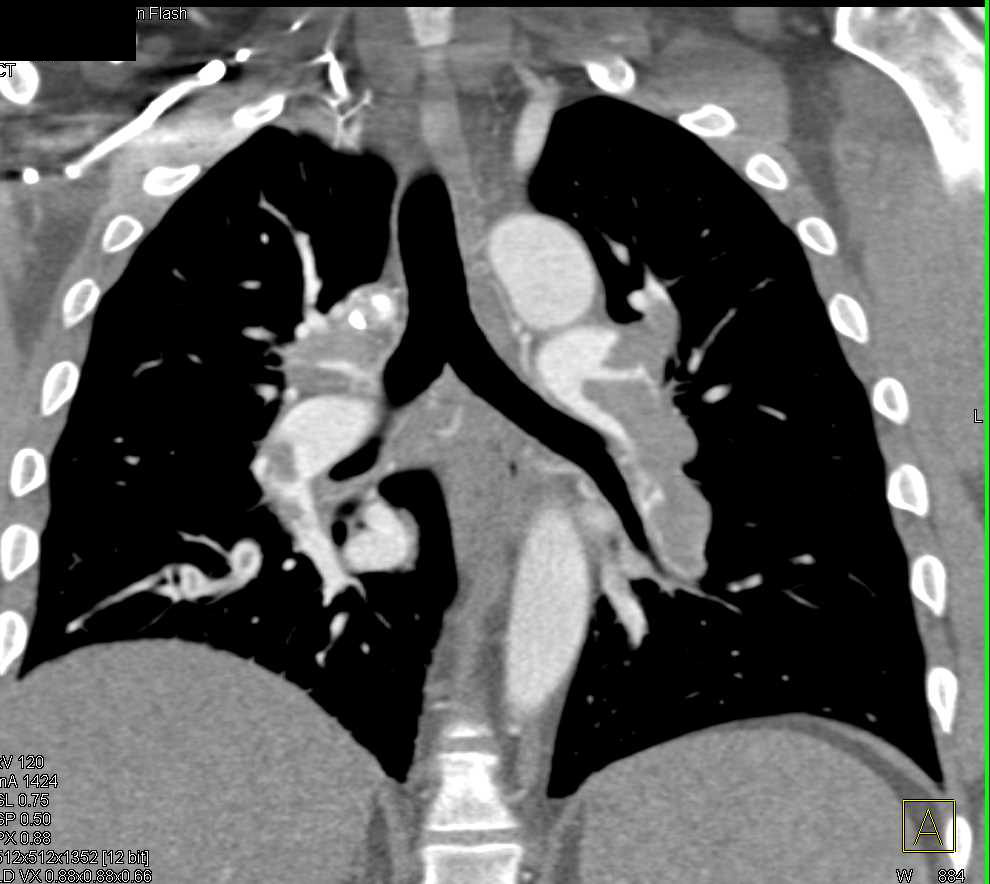 case study of pulmonary embolism