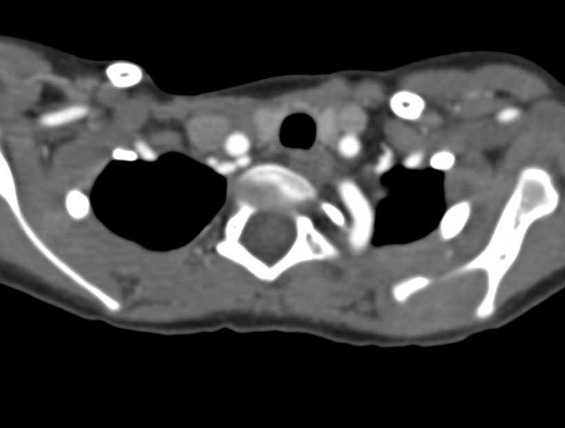 Severe Pectus Deformity and Tortuosity to Arch Vessels - CTisus CT Scan