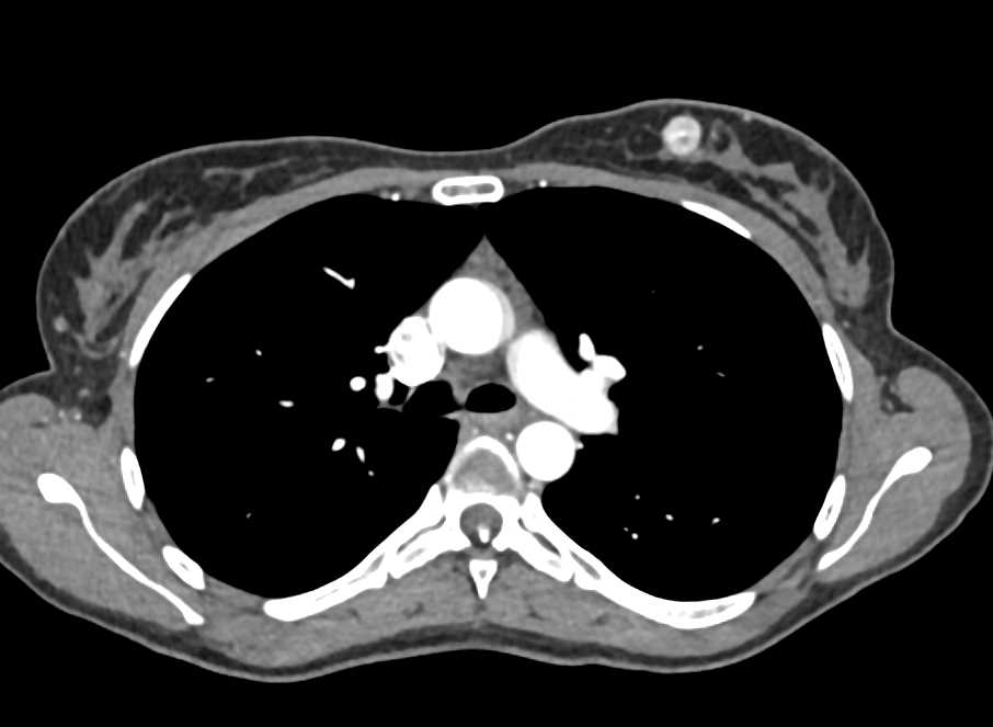 Carcinoma Left Breast - CTisus CT Scan