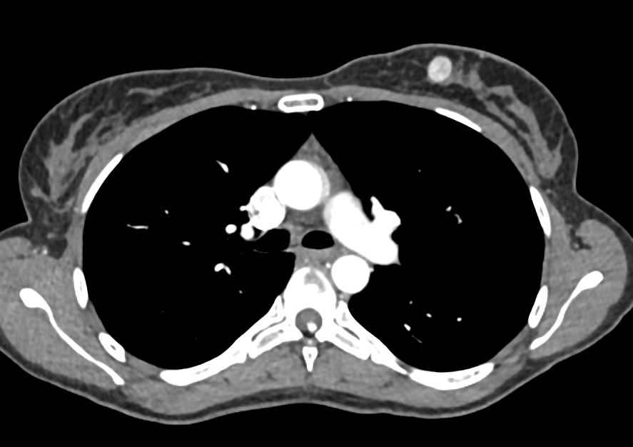 Carcinoma Left Breast - Chest Case Studies - CTisus CT Scanning