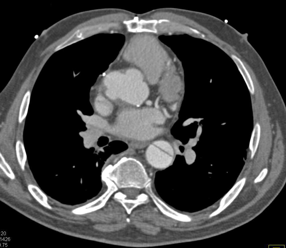 Type A Dissection with Repair - CTisus CT Scan