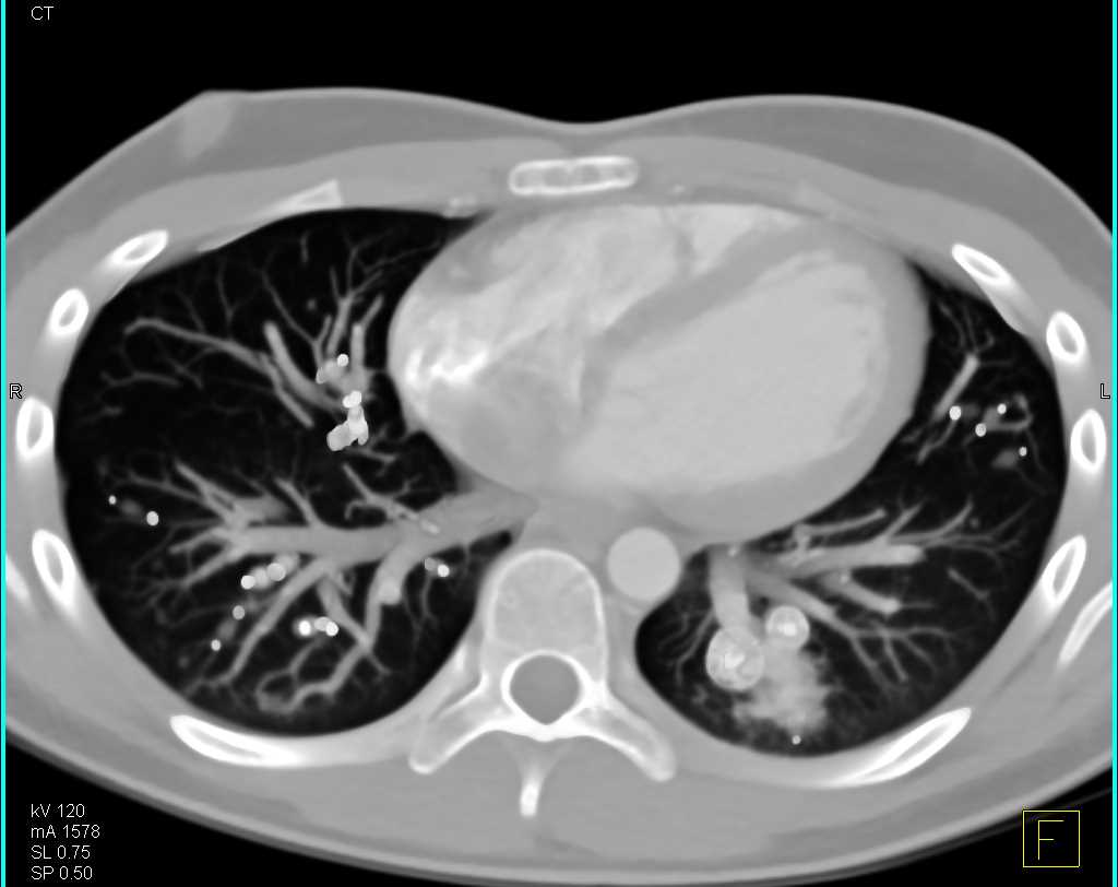 Multiple Pulmonary Arteriovenous Malformations (AVM) - CTisus CT Scan
