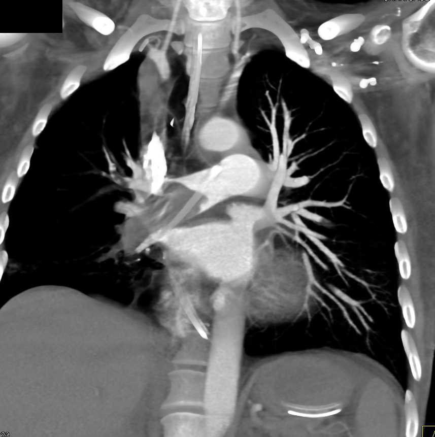 Large Right Mainstem Pulmonary Artery - CTisus CT Scan