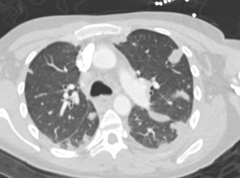 Septic Emboli - CTisus CT Scan