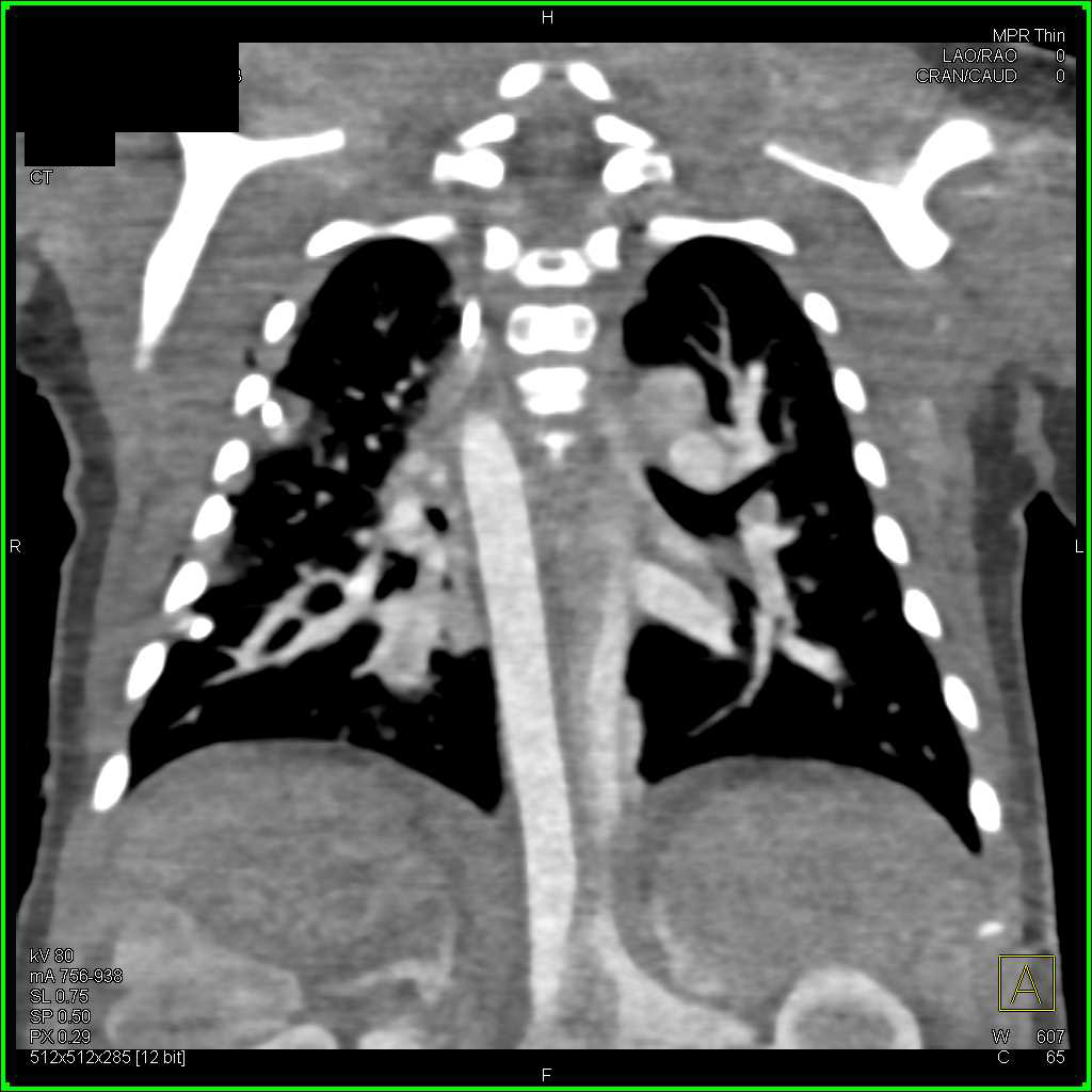Thymus in Child - CTisus CT Scan