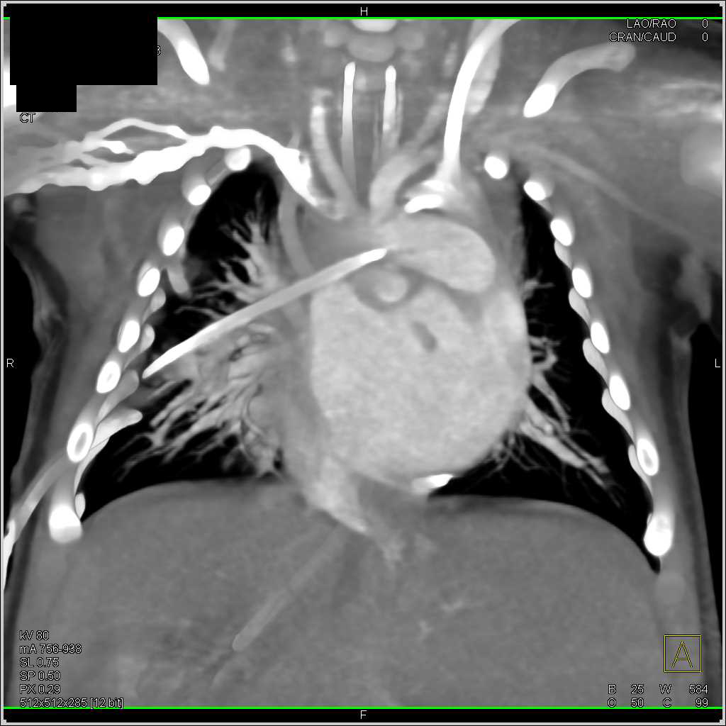 Thymus in Child - CTisus CT Scan
