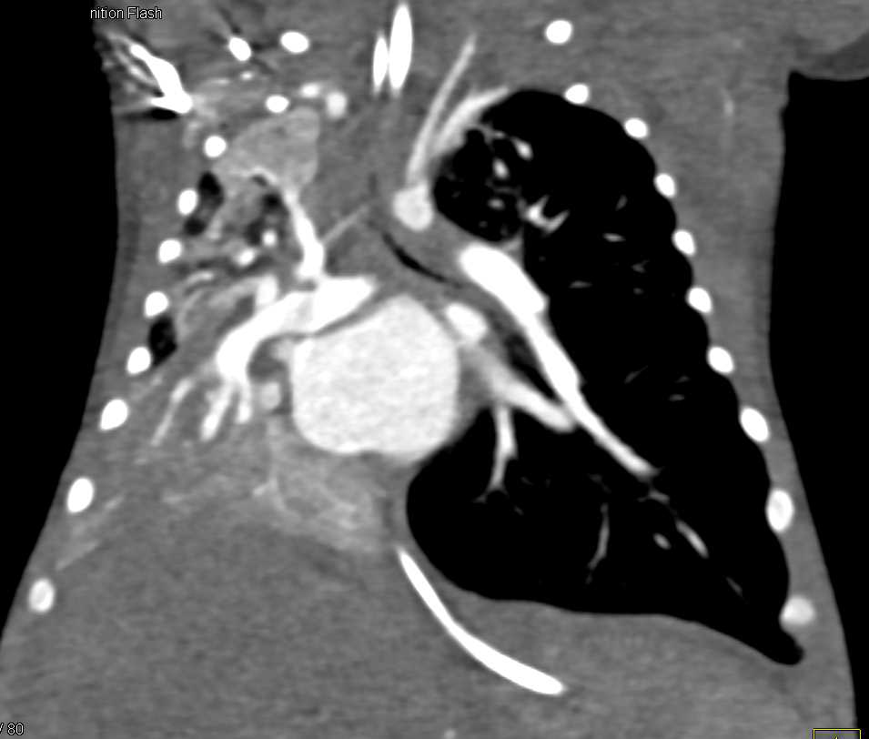 Occluded Right Upper Lobe Bronchus due to Stenosis - CTisus CT Scan