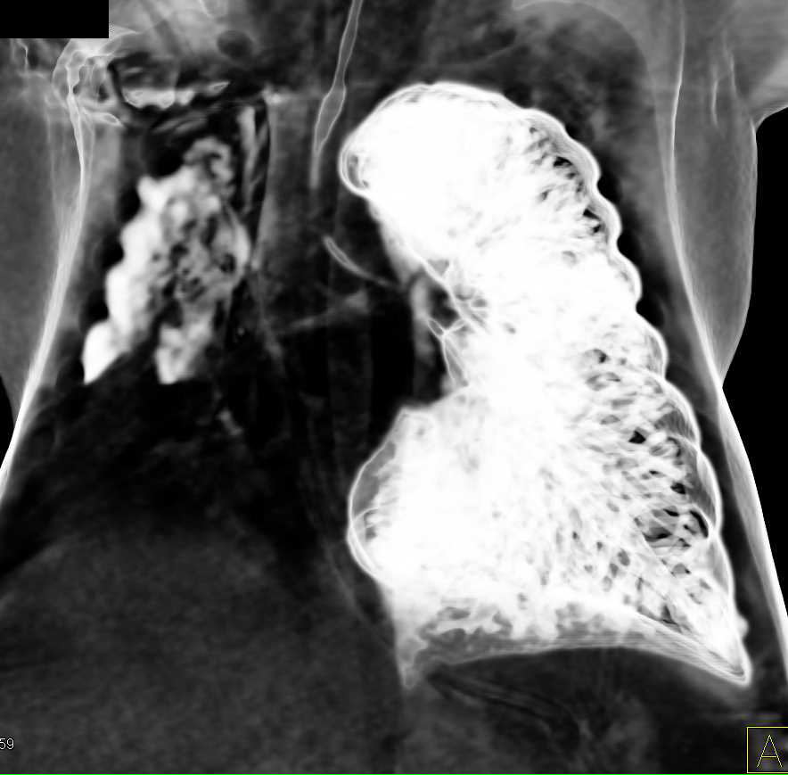 Occluded Right Upper Lobe Bronchus due to Stenosis - CTisus CT Scan