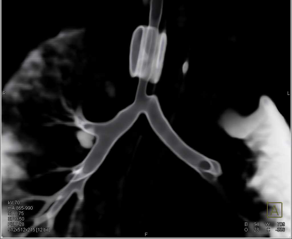 Tracheal Stenosis - CTisus CT Scan