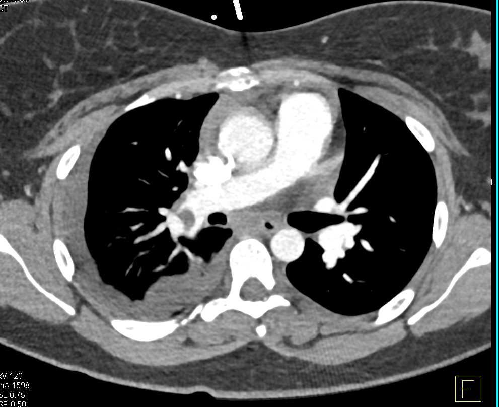 Large Pulmonary Embolism with Inferior Vena Cava (IVC) Clot - CTisus CT Scan