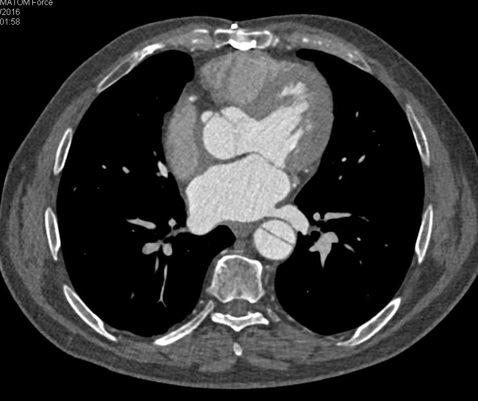 Aortic Dissection and Multiple Pulmonary Emboli - CTisus CT Scan