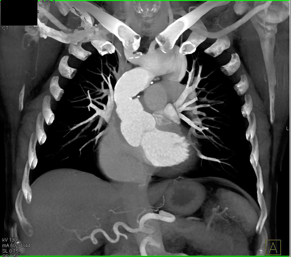 Aortic Dissection and Multiple Pulmonary Emboli - CTisus CT Scan