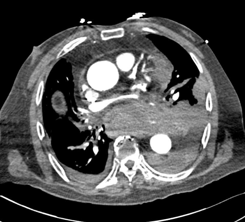 Type B Dissection with Active Contrast Extravasation - CTisus CT Scan