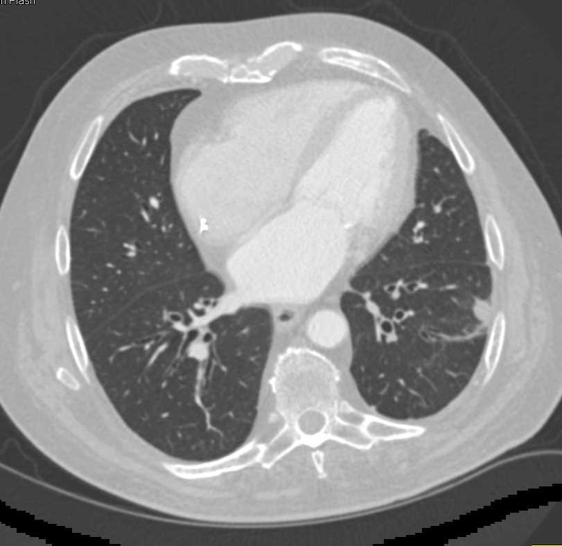 Pulmonary Infarct - CTisus CT Scan