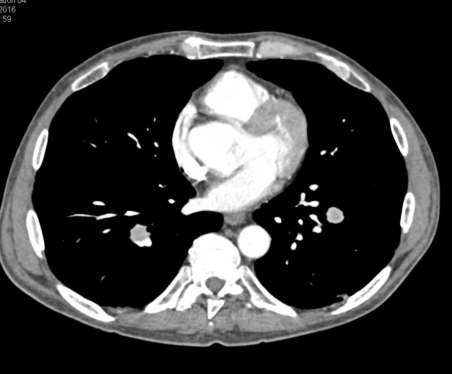 Bilateral Pulmonary Embolisms (PEs) and Carcinoid Tumor Root of Mesentery - CTisus CT Scan