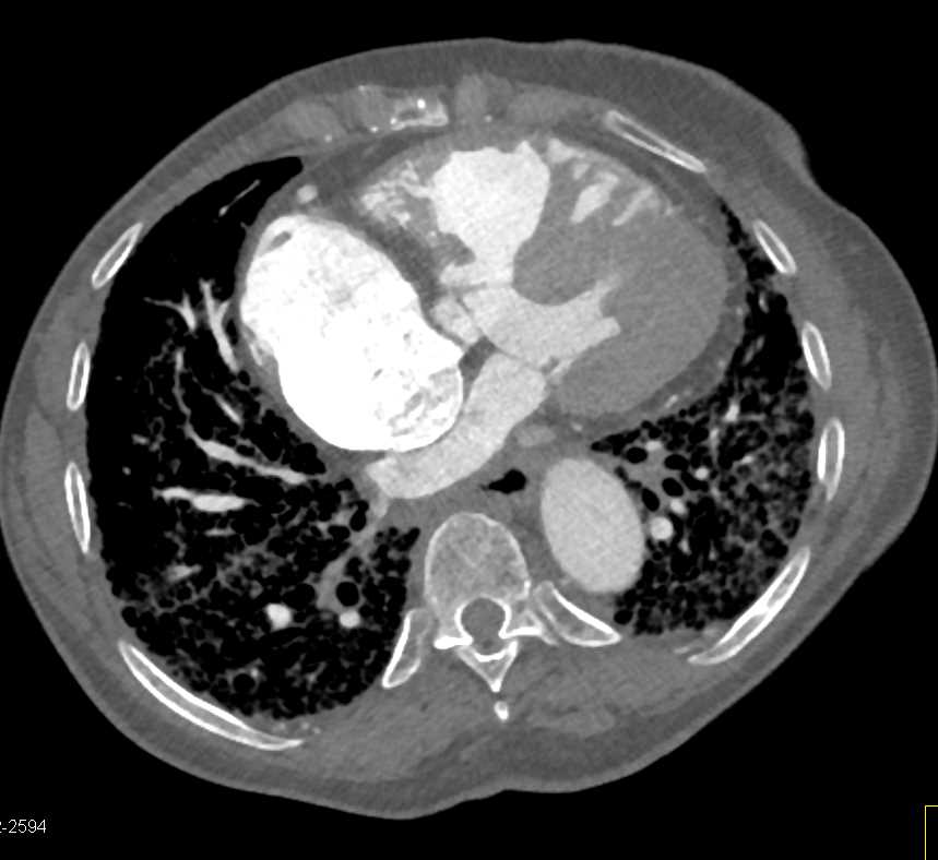 Scleroderma - CTisus CT Scan