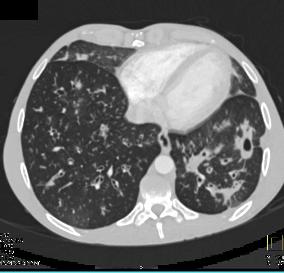 Cystic Fibrosis with Bronchiectasis and Portal Hypertension - CTisus CT Scan