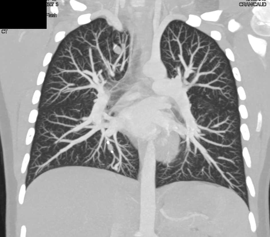 Small Arteriovenous Malformation (AVM) - CTisus CT Scan