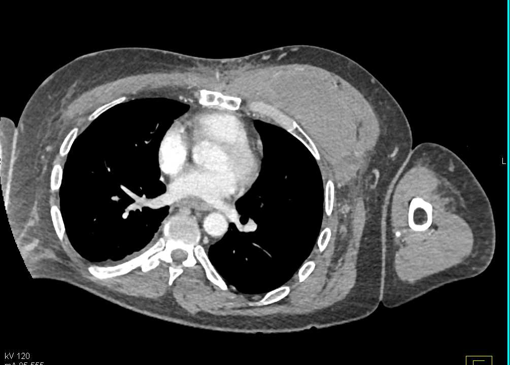 Reconstructive Surgery Left Breast - CTisus CT Scan