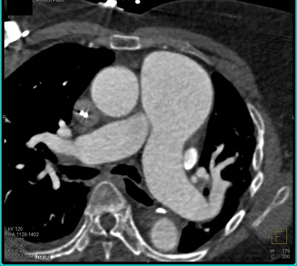 Dilated Main Pulmonary Artery and Persistent Left Superior Vena Cava (SVC) - CTisus CT Scan