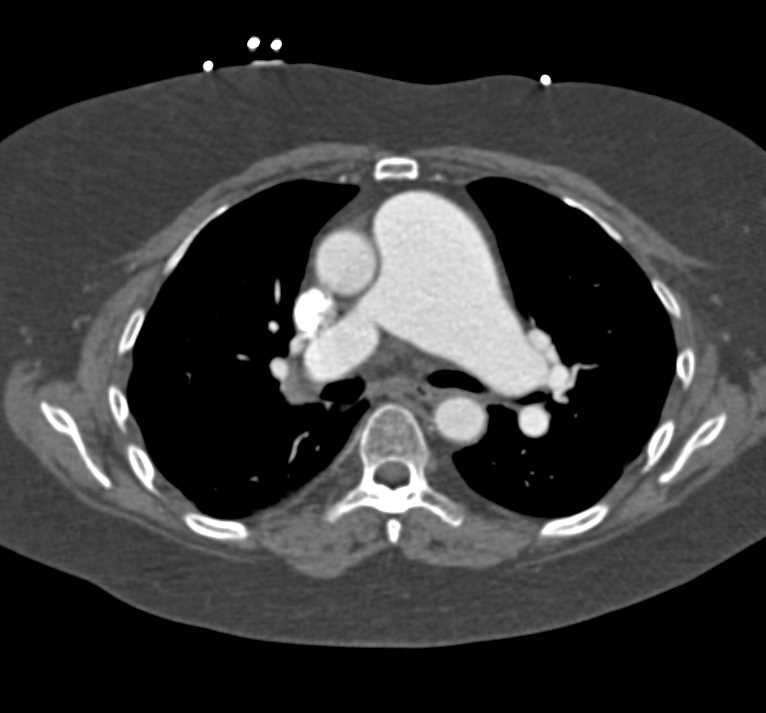 Dilated Main Pulmonary Artery - CTisus CT Scan