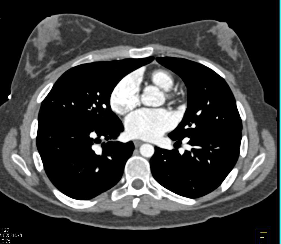 Sequestration Left Lower Lung - CTisus CT Scan