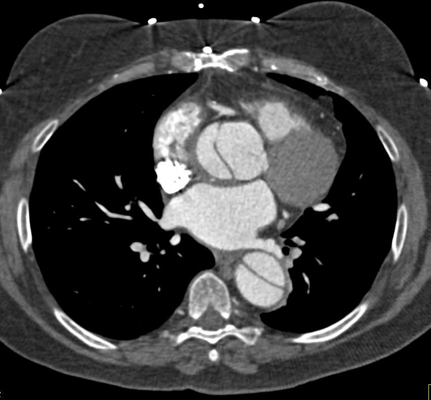 Type A Dissection - CTisus CT Scan