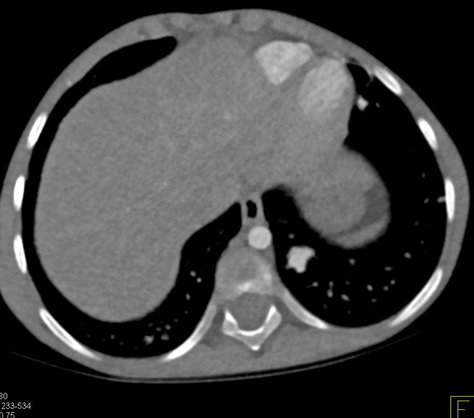 Multiple Pulmonary Arteriovenous Malformations (PAVMs) - CTisus CT Scan