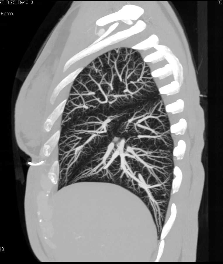 MIP of the Lung Parenchyma - Chest Case Studies - CTisus CT Scanning