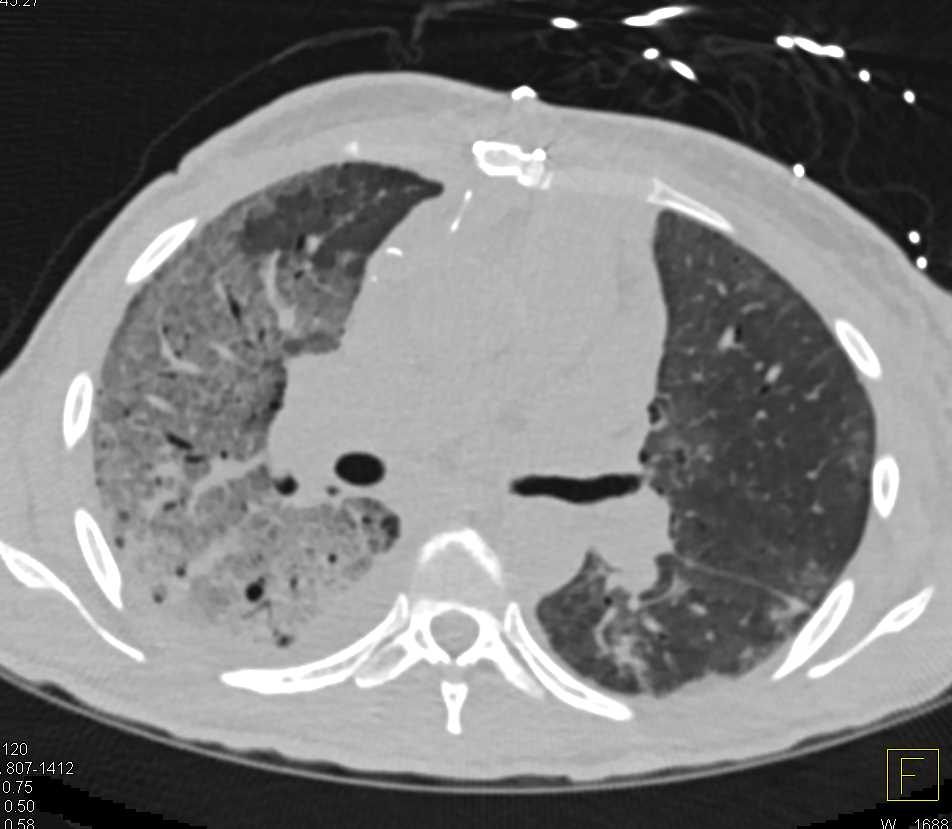 Pulmonary Hemorrhage in the Right Lung - CTisus CT Scan