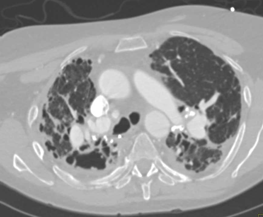 Sarcoidosis with Interstitial Fibrosis and Fungal Ball Left Upper Lobe - CTisus CT Scan