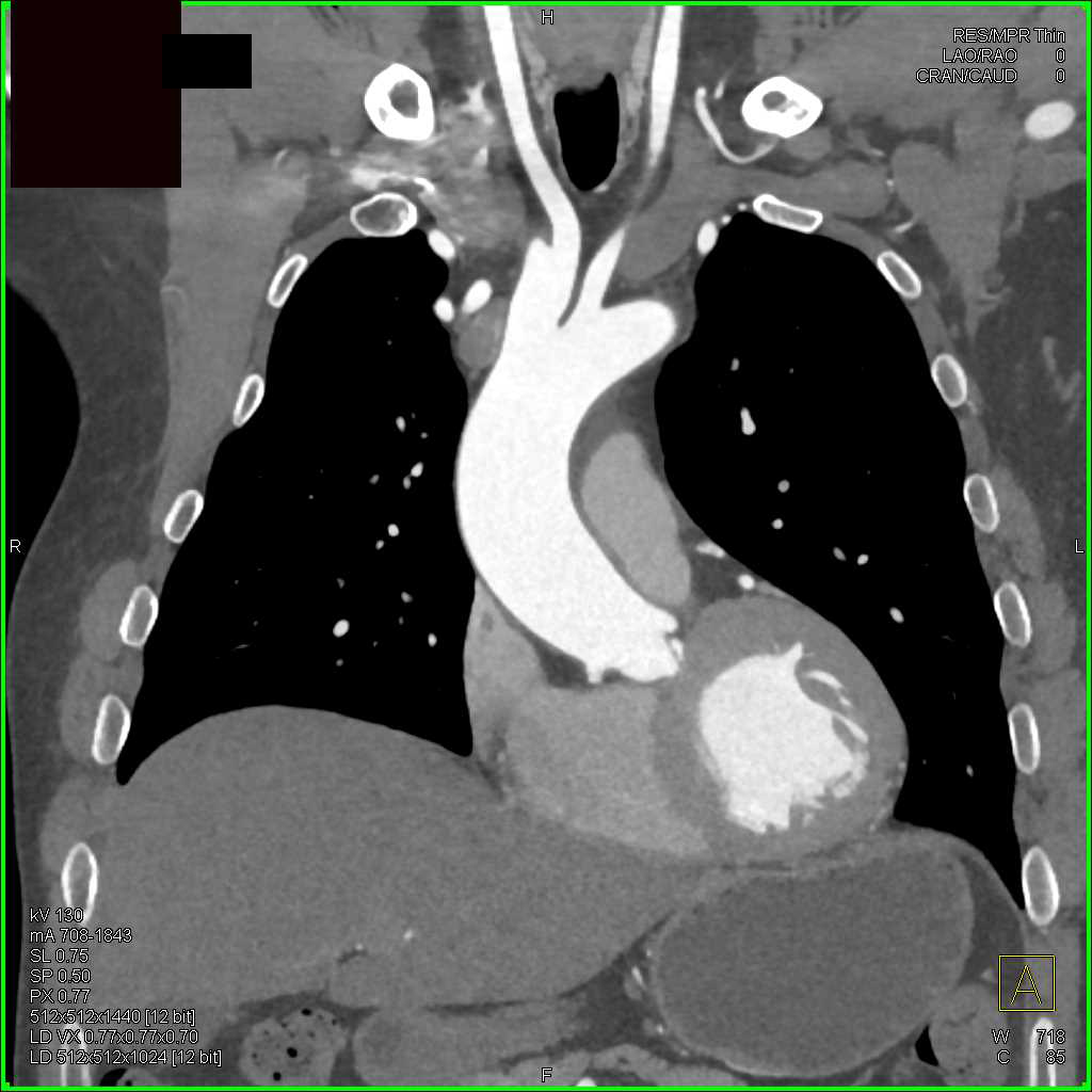 Mediastinal Collateral Vessels Including the Internal Mammary Arteries - CTisus CT Scan