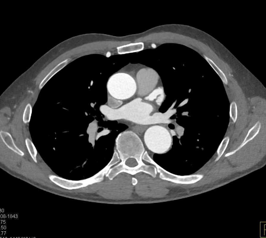 Coarctation of the Aorta with Mediastinal Collateral Vessels Including the Internal Mammary Arteries - CTisus CT Scan