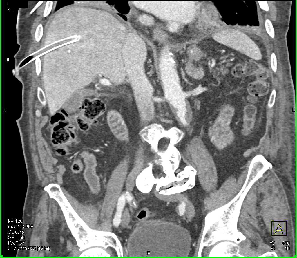 Chest Tube Placed in Liver - CTisus CT Scan